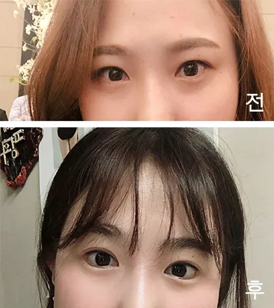 [眼睛] 뀨진아 - 後眼角切開,下眼瞼下至