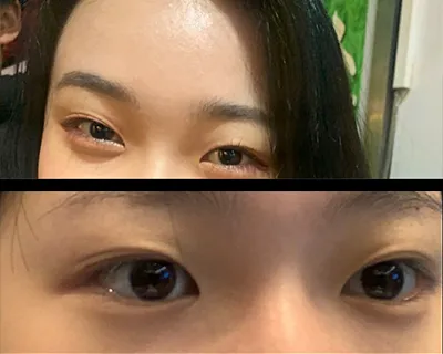 [眼睛] 智慧1 - 埋線,眼瞼下垂矯正