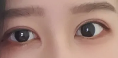 [眼睛] 므링 - 開眼頭、眼部重修手術