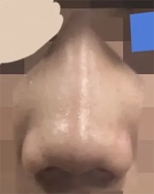 [鼻] 加納手術 - 鼻