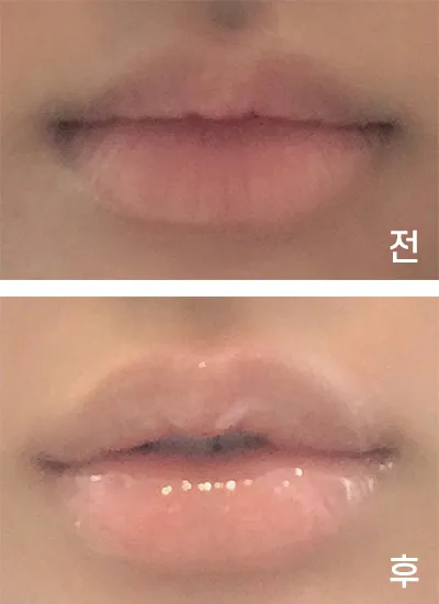 [微整形] ㅎ링ㅇ - 嘴角、嘴唇填充