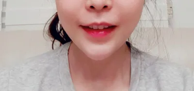 [皮膚] gus0311 - 填充劑、拉提