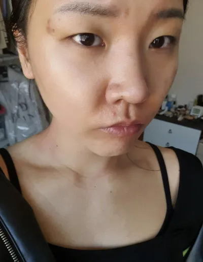 [眼睛] 彬娜亮娜 - 切開, 開眼頭眼尾