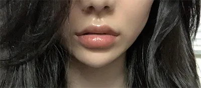 [微整] Chikiin - 填充劑、拉提