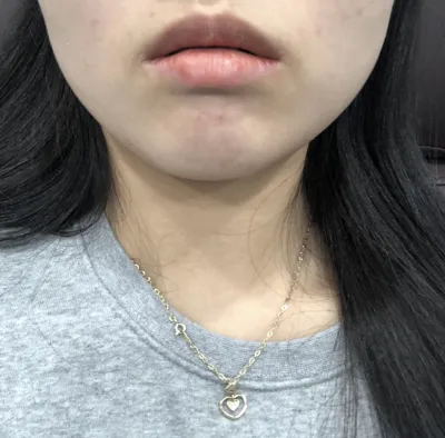 [微整形] soosooh - 肉毒桿菌、填充劑