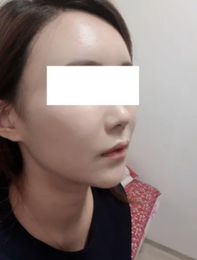 [抗衰老] 까렁이 - 全臉脂肪移植