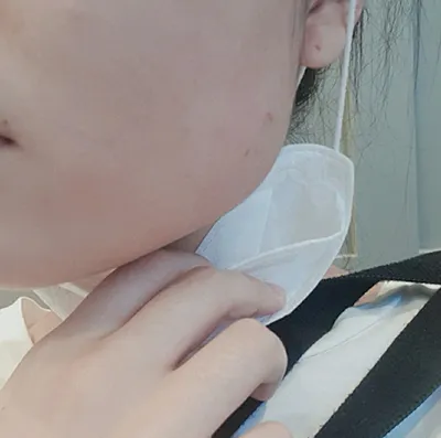 [微整形] seoul - 下顎肉毒桿菌