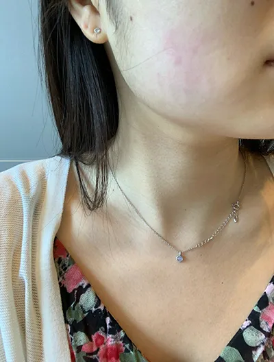 [皮膚] 咖啡牛奶斑 - Ultherapy超聲刀拉提