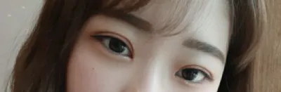 [眼睛] msdmsquf2 - 雙眼皮埋線、開眼頭