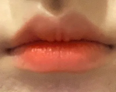 [微整形] Rapunzel@ - 嘴唇填充