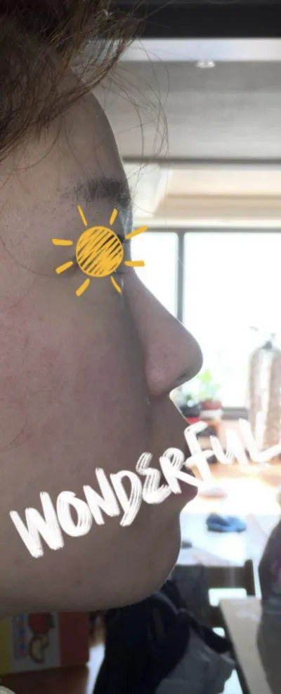 [鼻] Shee288 - 鼻樑、鼻尖