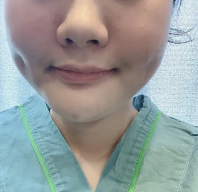 [抽脂] kimy226 - 臉部抽脂