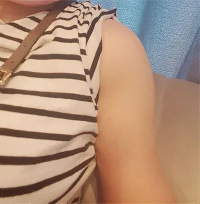 [抽脂] Lariole - 抽脂