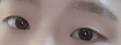 [眼睛] 李soo - 縫雙眼皮、開眼頭