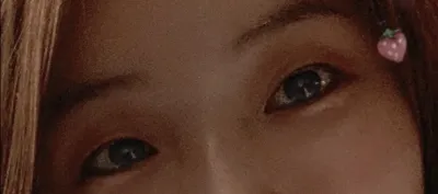 [眼睛] 哈哈哈哈 - 眼型矯正, 切開