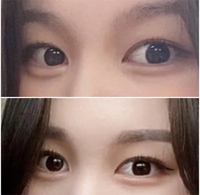 [眼睛] 연듀두 - 雙眼皮、開眼頭