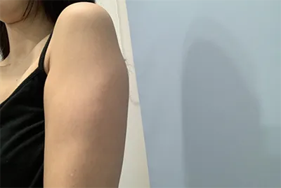 [抽脂] 꿀랄릴 - 手臂、副乳抽脂