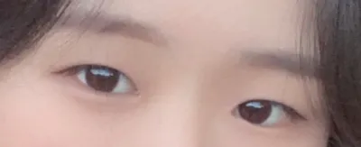 [眼睛] 0202u - 上眼瞼提拉術, 雙眼皮