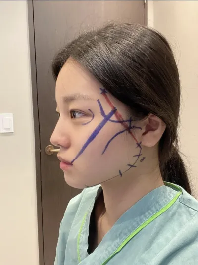 [顏面輪廓] 光州公主公主 - 顴骨、下巴尖、下顎角