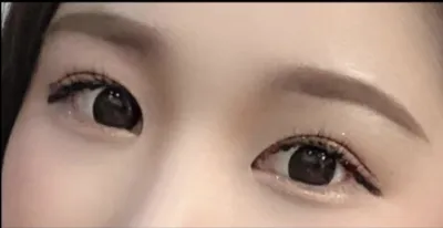 [眼部] sidhd22 - 後眼角切開,下眼瞼下至