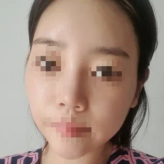 [鼻部] 粉紅色 - 鼻部、輪廓