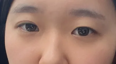 [眼部] My Melody - 眼、鼻手術