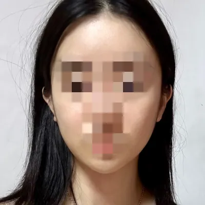 [顏面輪廓] Minvely - 顏面輪廓