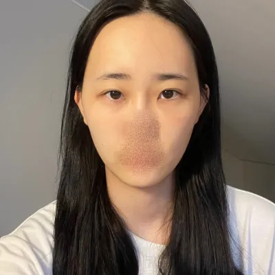 [眼睛] 三三五五 - 眼睛、脂肪移植、輪廓