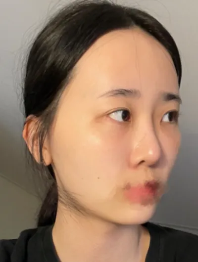 [眼睛] 熊人偶 - 眼睛、輪廓、脂肪移植