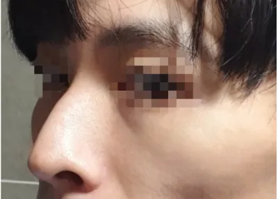 [鼻] 하루사리 - 鼻