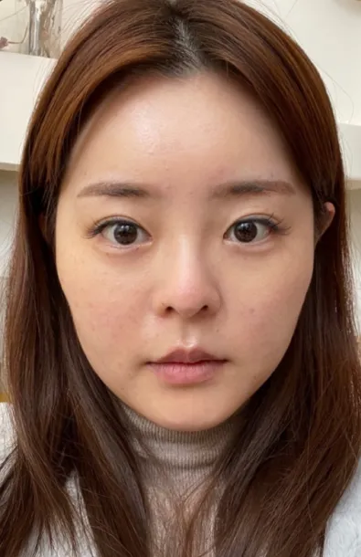 [眼睛] 兔兔呀 - 眼睛、鼻子、輪廓、臉部抽脂