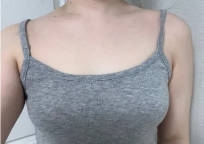 [隆胸] 碳酸 - 胸部