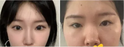 [眼睛] 蒜頭鼻 - 眼睛、鼻子