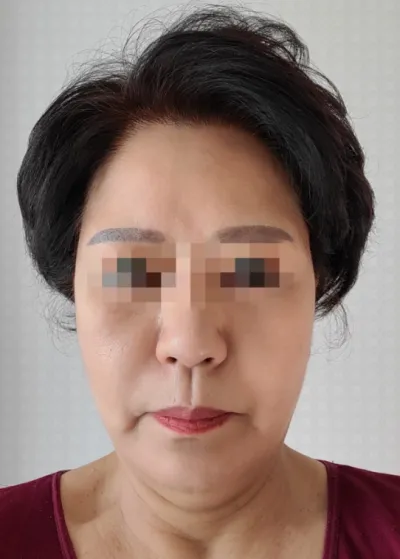 [抗衰老] 阿卡西亞 - 面部拉皮手術