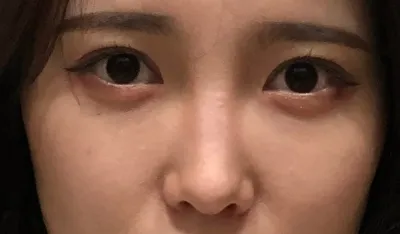 [鼻] 햇볕이 - 鼻 (陽光 - 鼻)