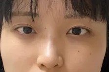 [眼部] 啵噼啵 - 眼、鼻