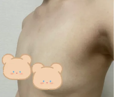 [隆胸] 룰라라 - 隆胸