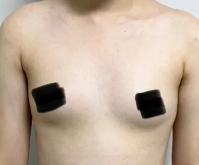 [隆胸] 歌婷 - 胸部