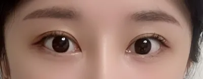 [眼部] 眼部整形 - 眼部