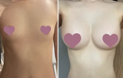 [隆胸] 翻天覆地 - 我的隆胸經歷