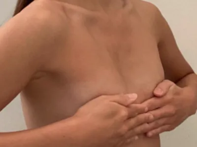 [隆胸] 檸檬糖蛋糕 - 胸部