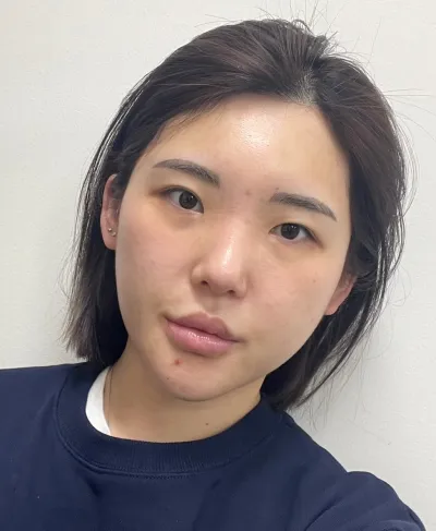 [眼睛] 蜜桃眼 - 非切開眼瞼下垂矯正（重修手術）, 上眼角切開, 下眼角切開