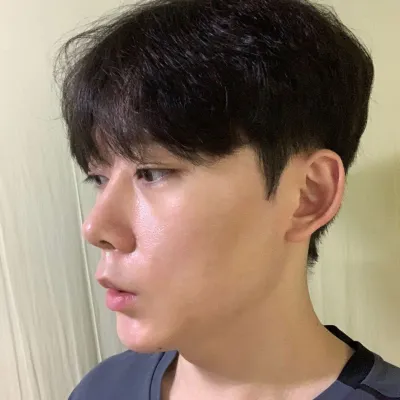 在韋伯斯整形外科沈正煥院長那裡做了鼻子手術已經兩週了