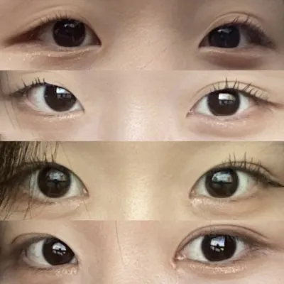 做了眼部手術 :)