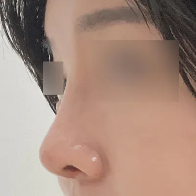 做了朝天鼻手術~! 