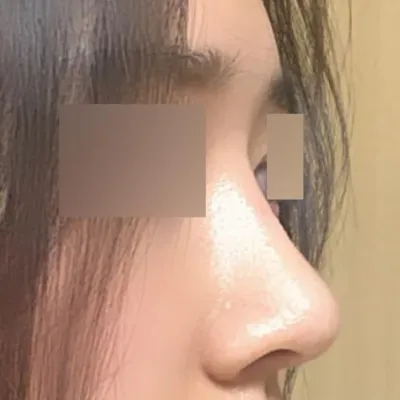 做了不對稱和蒜頭鼻矯正