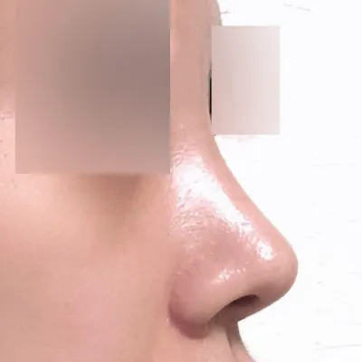 又短又塌的鼻子變得挺拔了