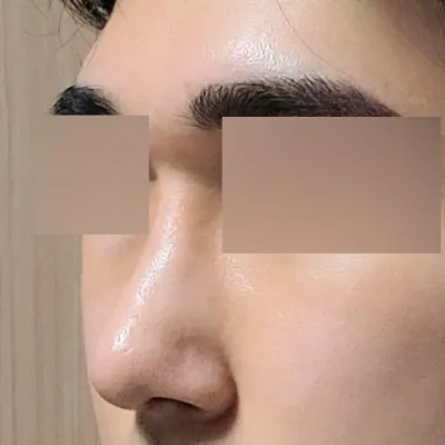 隆鼻一個月後記