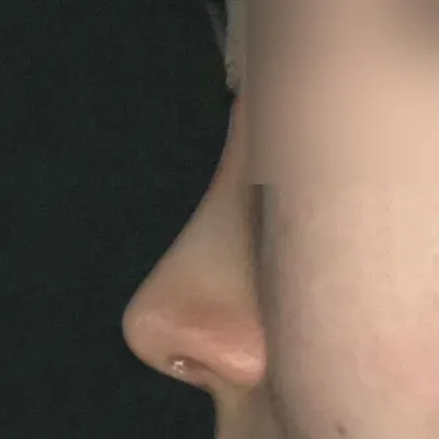 給Wievers整形外科徐承祖院長做完隆鼻手術已經一個月了！