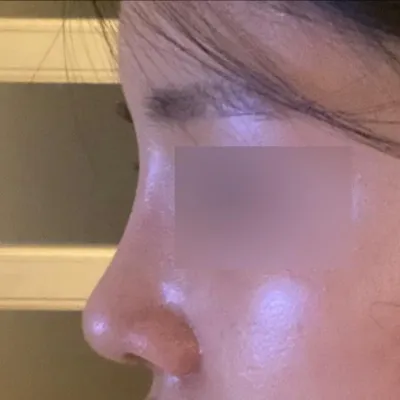 給徐承祖院長做手術一個月後的後記